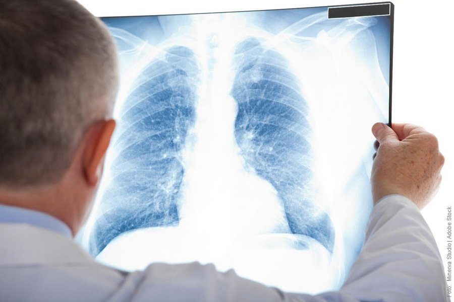 Intelligenza artificiale migliora la diagnosi del cancro al polmone 6 image 211 5