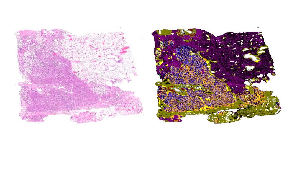 Intelligenza artificiale migliora la diagnosi del cancro al polmone 7 image 211 6