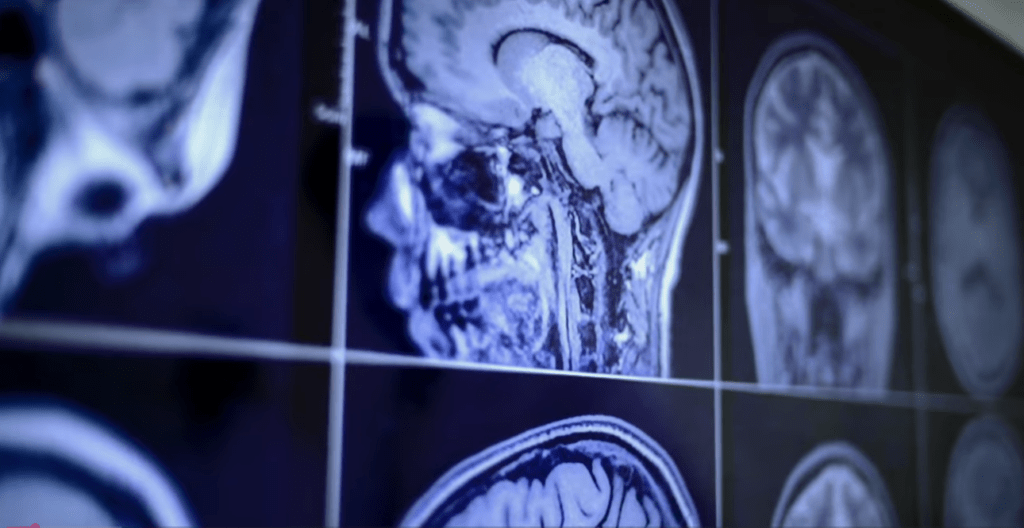 BISC: Il chip cerebrale wireless che trasmette i pensieri in streaming 6 image 457